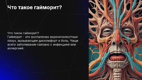 Гайморит
