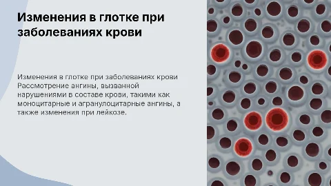 Ангиноподобные изменения в глотке при заболеваниях крови