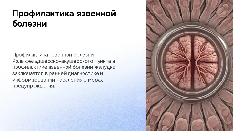 Профилактика язвенной болезни в условиях ФАП
