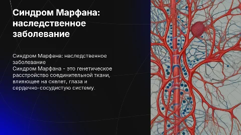 синдрома Марфана