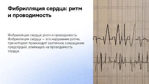 Фибрилляция сердца ритма и проводимости