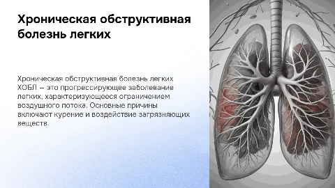 хроническая обструктивная болезнь легких