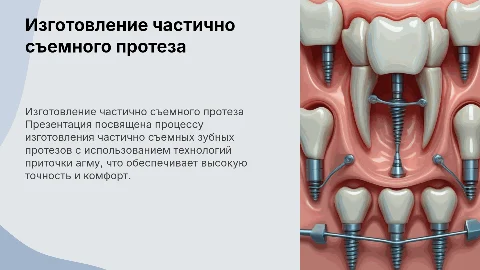 Изготовление частично съемного протеза: 20 слайдов