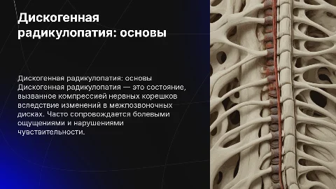 дискогенная радикулопатия