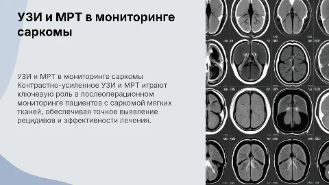 Контрастно-усиленное УЗИ и МРТ в мониторинге саркомы