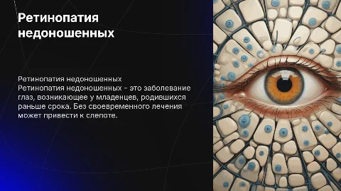 ретинопатия недоношенных