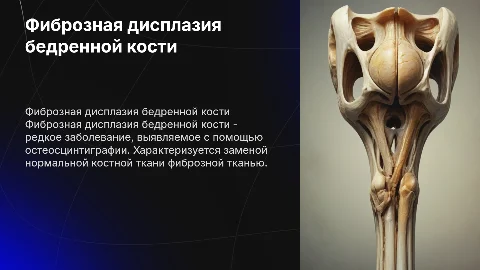 Фиброзная дисплазия бедренной кости на остеосцинтиграфии
