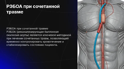 РЭБОА при сочетанной травме