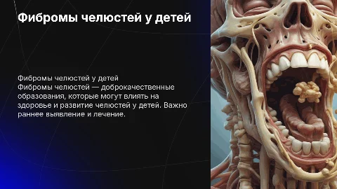 Фибромы челюстей у детей: презентация для студентов