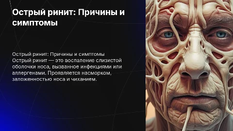 Острый ринит
