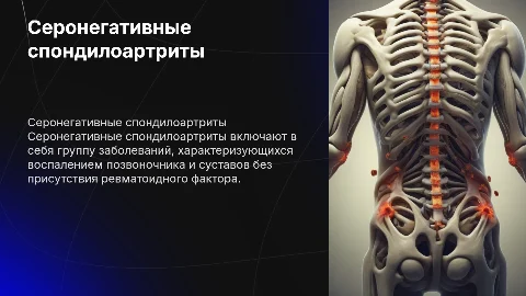 серонегативные спондилоартриты