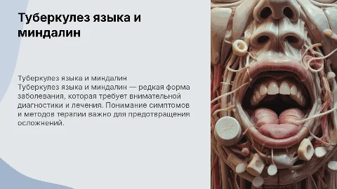 Туберкулез языка и миндалин
