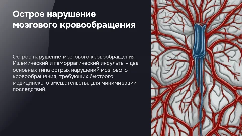 Острое нарушение мозгового кровообращения: ишемия и геморрагия