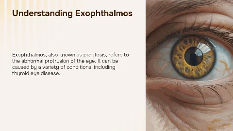 Exophthalmos