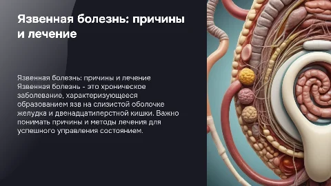 Язвенная болезнь