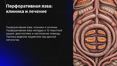 Перфоративная язва: клиника, диагностика и лечение