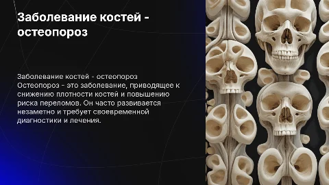 Заболевание костей - остеопороз
