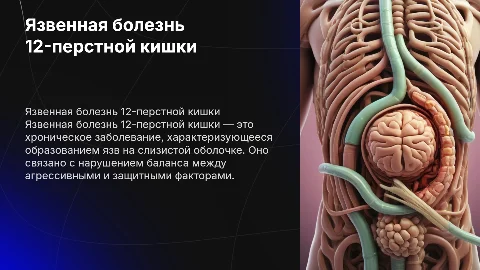 Язвенная болезнь 12-ти перстной кишки