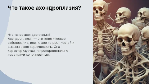 ахондроплазия