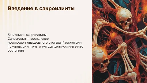 сакроилииты