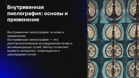 внутривенная пиелография