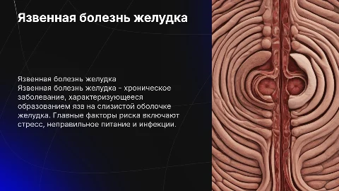 язвенная болезнь желудка