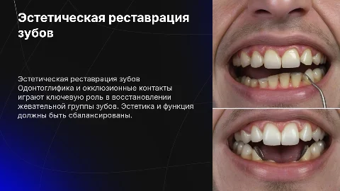 Эстетическая реставрация жевательной группы зубов и одонтоглифика