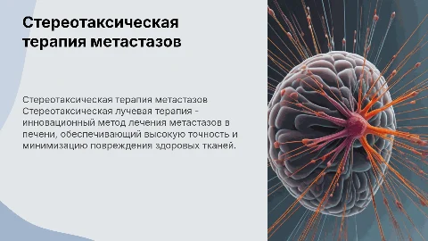 Стереотаксическая лучевая терапия метастазов в печени