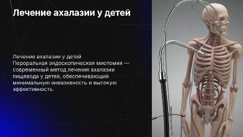 Лечение ахалазии пищевода у детей: пероральная миотомия
