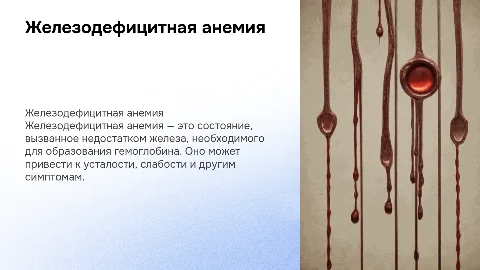 железодефицитная анемия