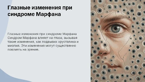 глазные изменения при синдроме марфана