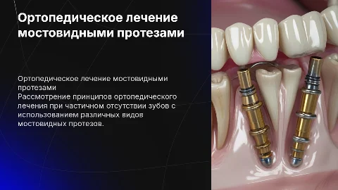 Принципы ортопедического лечения частичного отсутствия зубов