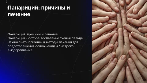 Панариций