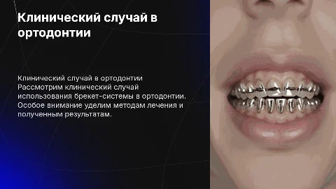 Клинический случай по ортодонтии на брикет системе