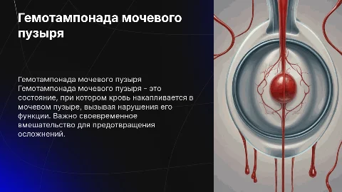 Гемотампонада мочевого пузыря