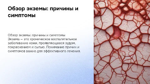 Тема :Экзема