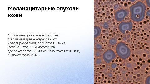 Меланоцитарные опухоли кожи