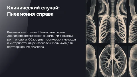 Презентация по клиническому случаю пневмонии справа